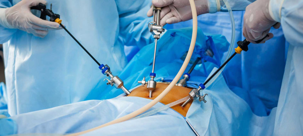 Responsabilità dei sanitari per lesione ureterale prodotta in chirurgia laparoscopica